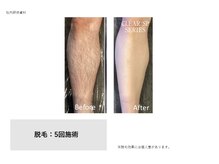 フェレザ 新潟(Felleza)/時短脱毛◎全身30分で完了