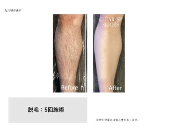 フェレザ 新潟(Felleza)/時短脱毛◎全身30分で完了