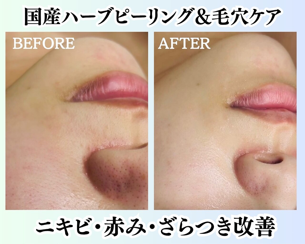 名古屋市瑞穂区で毛穴ケアが人気のエステサロン｜ホットペッパー