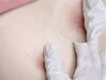 【ローマピンク】部位：乳輪/乳頭★通常価格220,000円