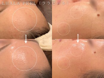 コアラル 麻布十番(COALALU)/韓国美容/ララピール水光肌/毛穴