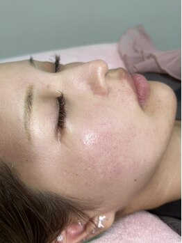 ヴィーナス(Venus)の写真/【まずは一度体験してほしい!】圧倒的な化粧ノリの違いに驚く!VenusのフェイシャルWAXでうるツヤ肌に…☆