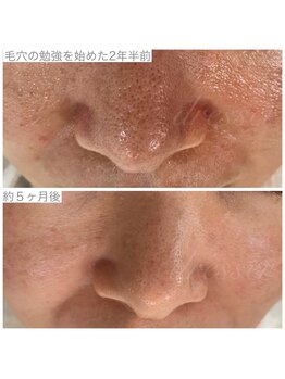 ドレッサー(Dresser)/諦めた毛穴もかわれました!