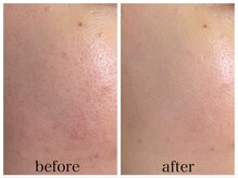 アリエス/ハイドラ×美白フォト１回の変化