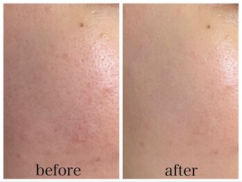 アリエス/ハイドラ×美白フォト1回の変化