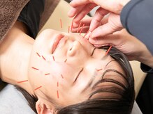 整骨院鍼灸院アシスト/大人気な美容鍼♪