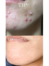 ミエル(miel)/【ハーブピーリング】ニキビケア