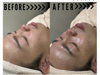 シュウア(SyuA)/メンズ韓国水光肌ピーリング