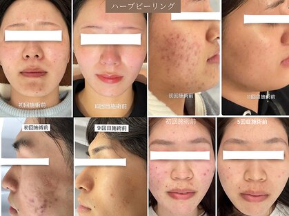 ヒジ(Life Salon)の写真