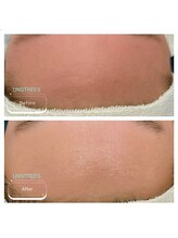 スー 千種 今池(Suu.)/敏感肌必見◎ミルクピーリング