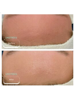 スー 千種 今池(Suu.)/敏感肌必見◎ミルクピーリング