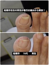 巻き爪じゅん 千葉駅前店/男性が巻爪の痛みから解放！