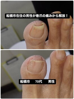 巻き爪じゅん 千葉駅前店/男性が巻爪の痛みから解放！