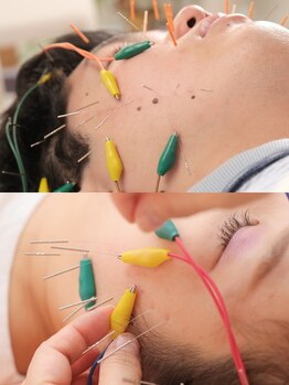 ホウレイ線・たるみ改善！予防ケア