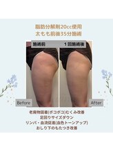 ルアナ(Luana)/脂肪分解＆燃焼！引き締めケア