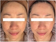 メゾンリュバン 梅田店(Maison Ruban)/ダクトピール｜シミしわ透明感