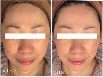 メゾンリュバン 梅田店(Maison Ruban)/ダクトピール｜シミしわ透明感