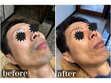 ヘアーズヨシオカ(HAIR'S YOSHIOKA)の雰囲気（お顔ツルツルを目指す方は、20回前後の施術が目安です！）