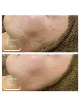 スー 千種 今池(Suu.)/＜症例＞敏感肌必見◎