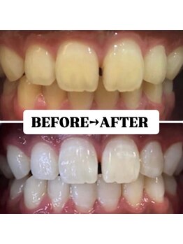 ホワイトニングサロン 豊中/Before&After美白ホワイトニング