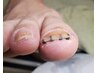 【巻き爪矯正】施術後すぐに効果を実感◎フットバス＆ケア付き◎16,500円