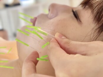 サロンドベベ(salon de Bebe.)の写真/【”見た目印象”変わる。肌の奥から引き締めるBebe式小顔美容鍼】
