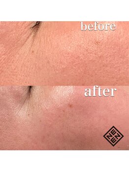 エン(EN)/1回の施術で実感体験メニュー