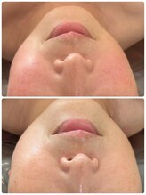 ジュエルビューティー(Jewel Beauty)/ダクトピール1回目