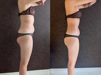 taiON.【ピラティス/温活/よもぎ蒸し】/ハイパーナイフ７＋ピラティス