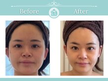 美人バスト 本厚木店/【小顔コルギ】◇症例