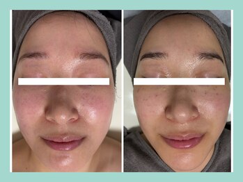 ミウル 天王寺店(miulu)/シミ照射