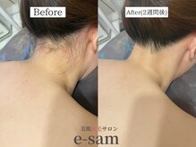 イーサム(e-sam)/丸ごと全身脱毛