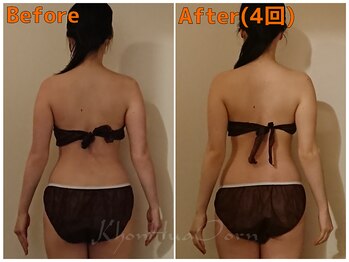 ボディメンテナンスサロン コンフアオーン/ブライダルエステ施術のお客様