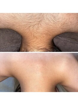 カレン 福岡東店/脱毛の症例！