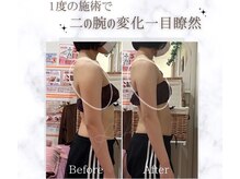 ラフィール/二の腕引き締め：1回 一目瞭然