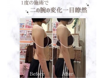 ラフィール/二の腕引き締め：1回 一目瞭然