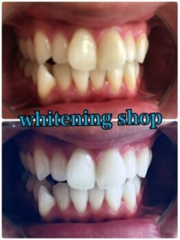 ホワイトニングショップ 池袋店/頑固な黄ばみにもホワイトニング