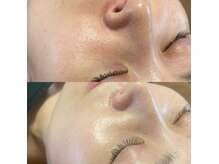 プレジール(Plaisir)の雰囲気（月に一度お肌に栄養をいれていくバクテリウムピール！）
