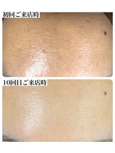 スティーン(Styin)/顔ワックス脱毛【京丹後】