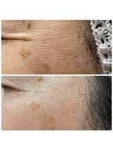 レイラニア(Leilani.Am)/マツヤニデトックス