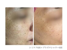 ルーム(room)/シミケア6回＋シャワー6回