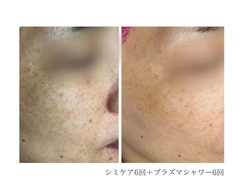 ルーム(room)/シミケア6回＋シャワー6回