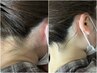 【女性限定】髪を上げても怖くない！うなじ脱毛