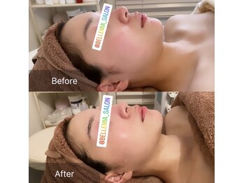 ベルミア(Bellemia)/Revi陶肌トリートメント