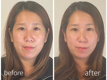 アップル マリー 江別/■小顔矯正