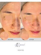 セローナ(Selona)/施術直後