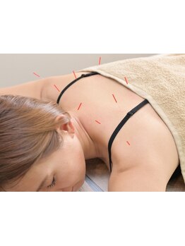 鍼灸施術を受けたい