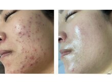 エクセレントビューティーサロン 艶(EN)/赤み・ニキビ改善