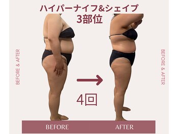 コリ チル(Kori Chill)/【ハイパーナイフ＆シェイプ】