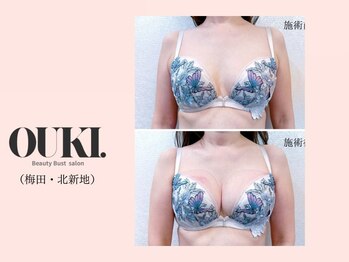 オウキ 梅田北新地(OUKI.)/バストアップ結果写真